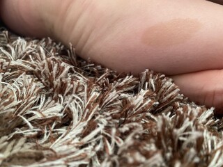 Worried about Café au lait marks?