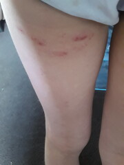 Rash on dd