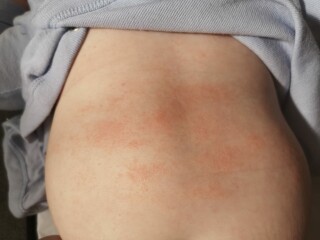 Baby Vaccine side effects