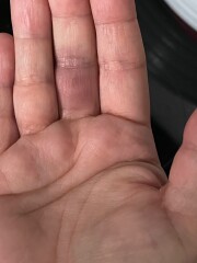 Achenbach syndrome - help, please!