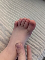 Spoon shaped nails