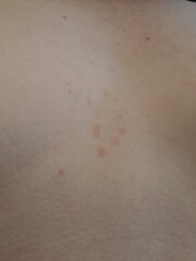 Weird blotches on skin - any ideas?
