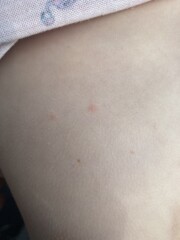 Chicken pox??