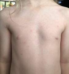 Chicken pox??