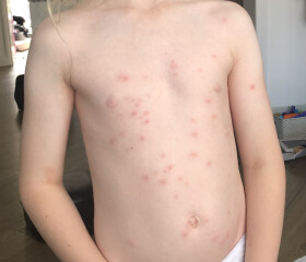 Chicken pox??