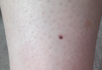 Cherry Angionoma or Nodular Melanoma?