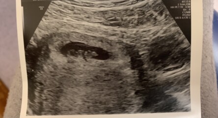 Pregnancy after miscarriage