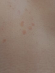 What are these blotches multiplying on me...