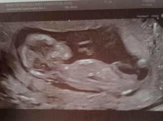 13 weeks scan, guess gender?