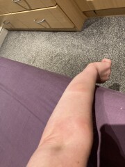 What has bitten me?!