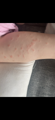 Please help - eczema or ringworm?!