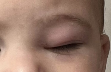 Does this look like periorbital cellulitis? 