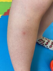 Can you identify these bites? 