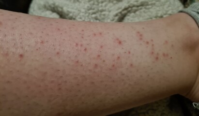 Help me identify this rash and stop the itch!