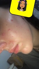 Spotty skin