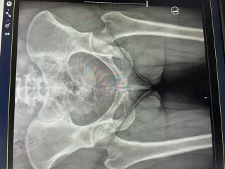 X-rays 