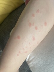 Is this eczema? (With pics)