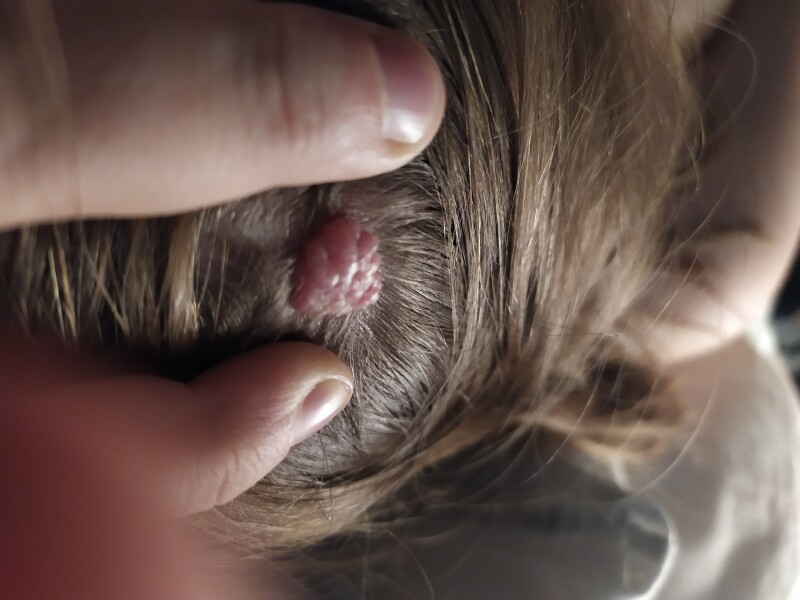 Growth on head - advice (gross pic attached)