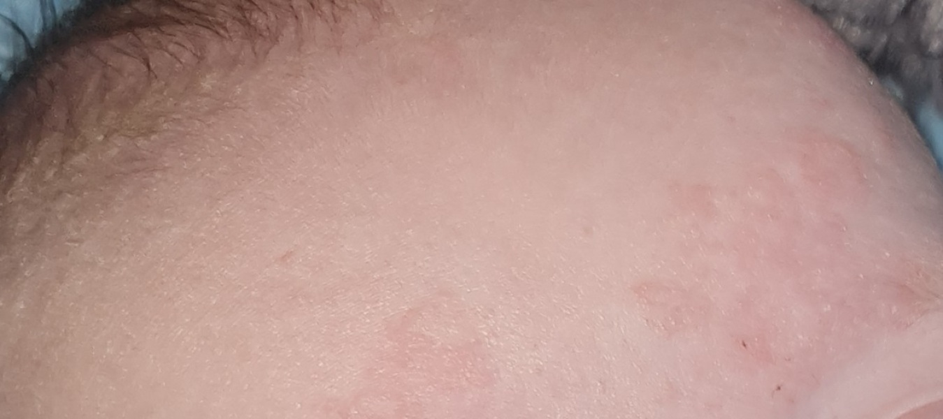 Rash....?