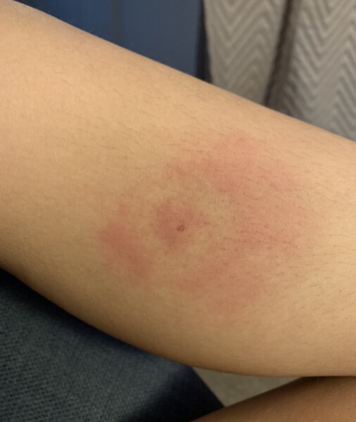 Is this a tick bite /start of Lyme? 
