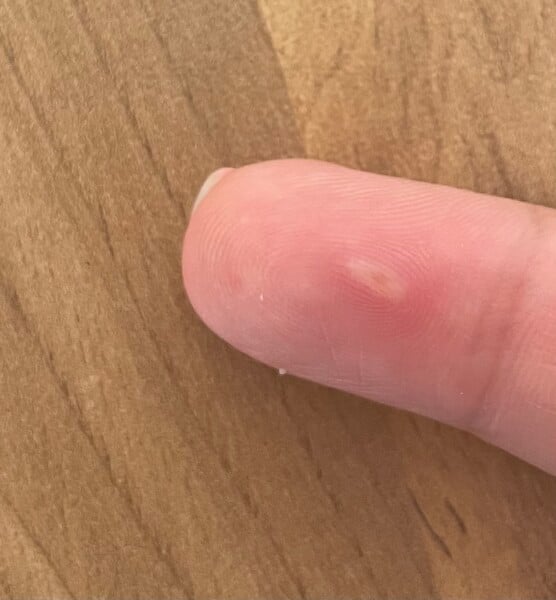 What is this lump? Appeared overnight 