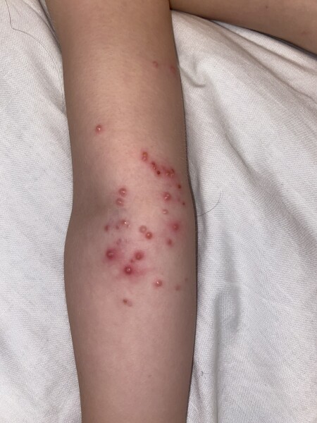 Treatment ideas - molluscum contagiosum?