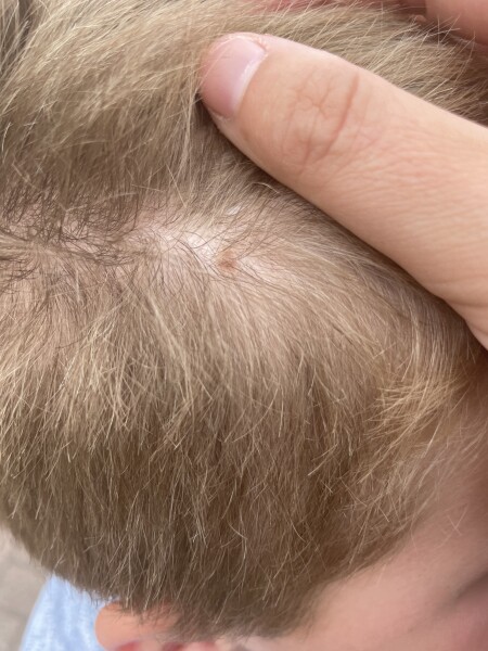 Mole on sons head ??