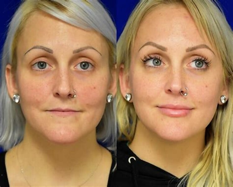 Bit of Filler... husband furious!