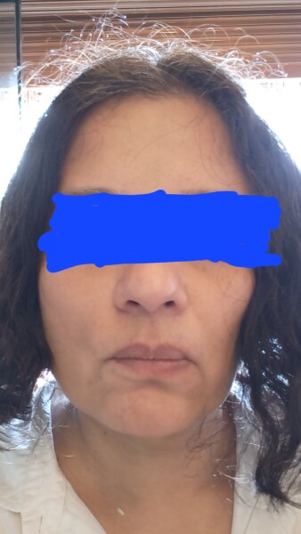 Botox and fillers