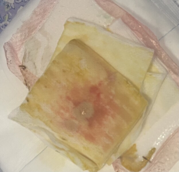 AIBU to go A and E ? Photo warning 