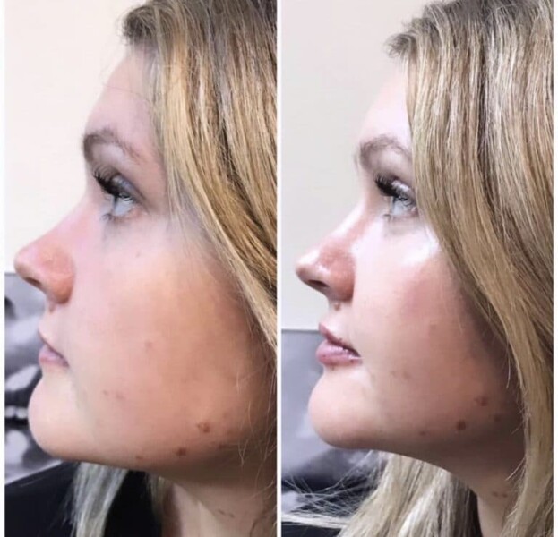 Bit of Filler... husband furious!