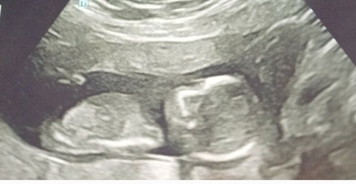 Scan when obese