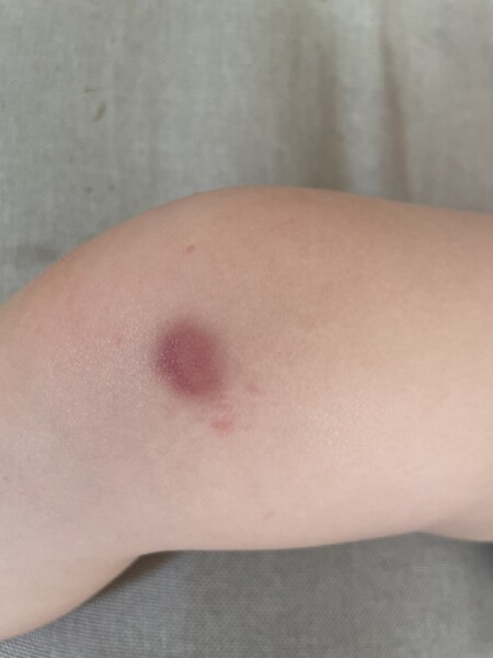 Bruise on toddler leg turned from black to red. Photo included.