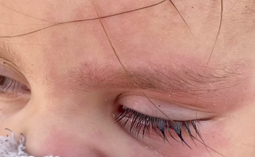 Toddler - sun / suncream / allergy?