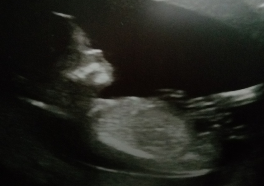 TTC immediately after miscarriage 