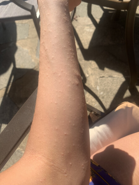 What is this rash? Pic