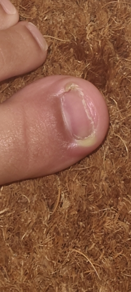 4 year old ingrown toenail