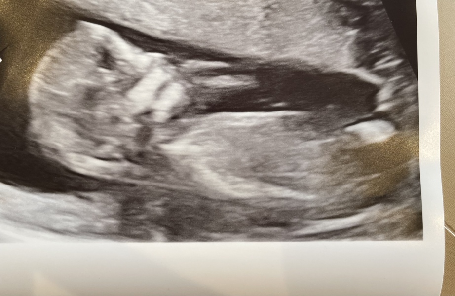 Boy or girl - Nub/skull guesses welcome :)