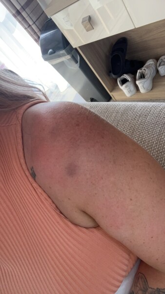 So itchy