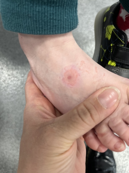 Possible Lyme disease - 4 year old DS