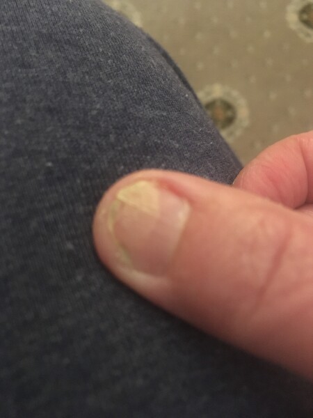 Does this look like an ingrowing toenail?