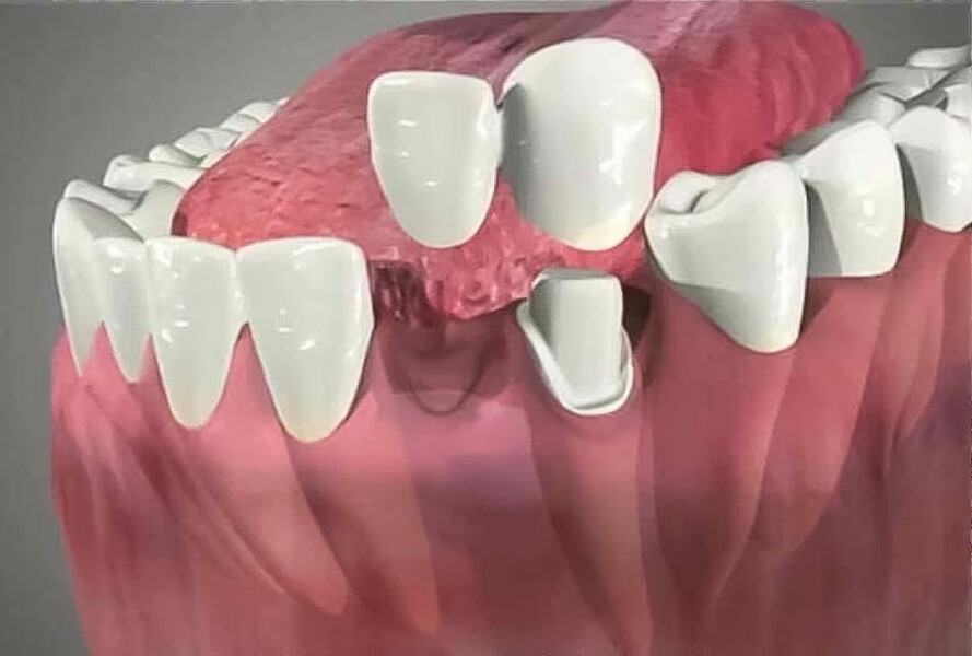 Single false tooth for 24 year old daughter. 