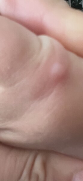 Are these chicken pox ?