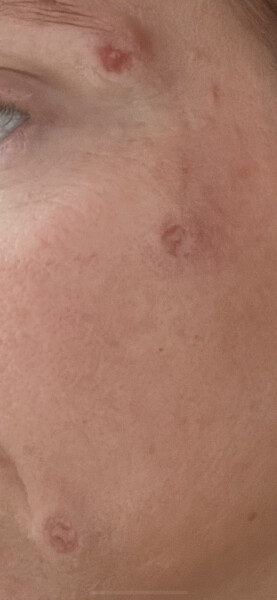 Mole removal from face- any recs?