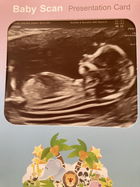 12 week scan! Nub theory - Any ideas??? 😄😄😄