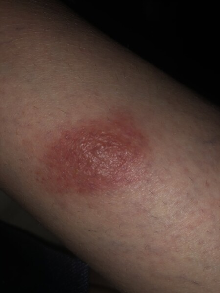 Insect bite flare up advice needed (with photo)