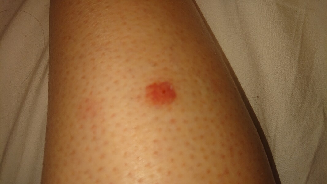 What has bitten me?! 