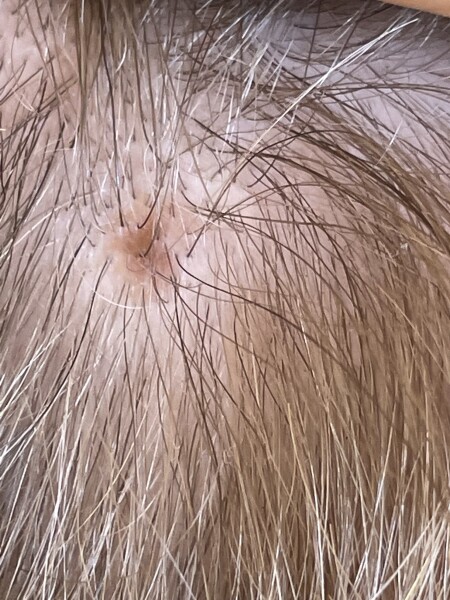 Mole on sons head ??