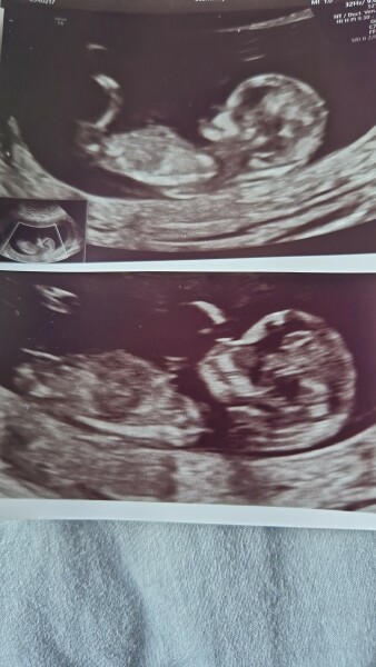 Hcg 1575 but nothing seen on scan!