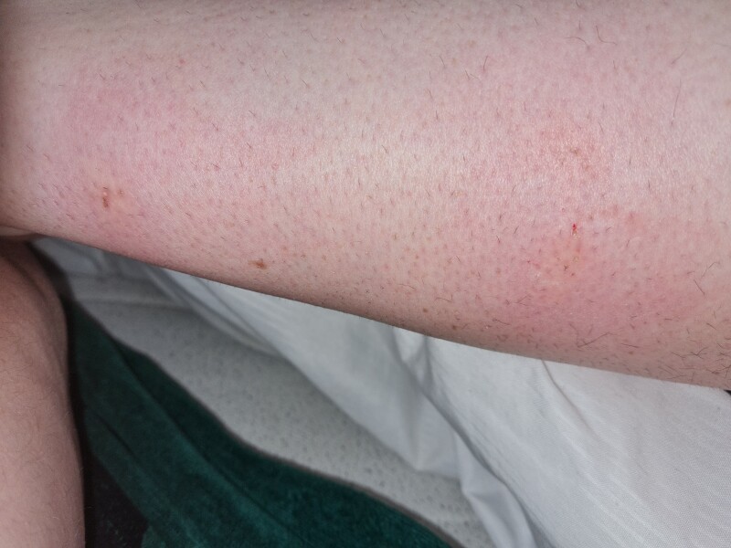 What has bitten me?!